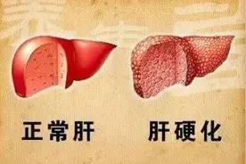 肝硬化对人体都有哪些危害？有时它比肝癌还可怕图片