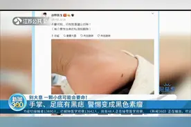 一颗小痣可能会要命！手掌、足底有黑痣？警惕变成黑色素瘤！视频封面