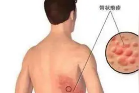 “缠腰龙”有疫苗了！7月起京沪市民可接种视频封面