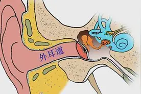 一夜醒来左耳听不见了 医生从患者耳朵里挖出一大块发霉物图片
