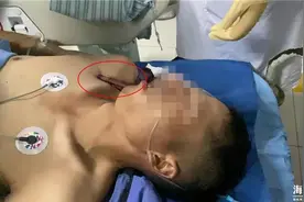 突发！太疼了，60厘米长钢筋贯穿海宁一工人身体，刺入脸颊……图片