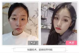 青岛伊美尔汪帅：5S重睑术解决眼部问题，眼睛灵动有神图片