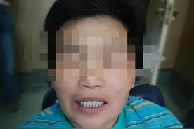 63岁老人多半牙齿已掉光，竟然又长出了人生第三副牙齿图片