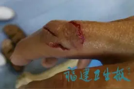 漳州一阿婆杀鱼时手被刺伤，3天后生命垂危，截肢保命图片