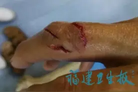 漳州一阿婆杀鱼时手被刺伤，3天后生命垂危，截肢保命图片