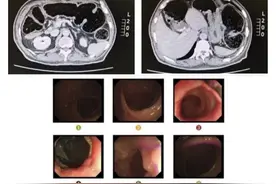 男子“怀胎”29载？！腹腔镜手术切除先天性巨结肠图片