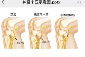 “报复性”运动后累垮神经 腓总神经卡压松解立竿见影图片