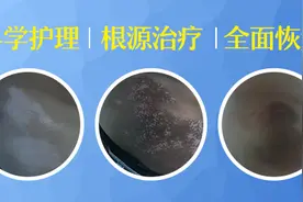 杜绝这几个坏习惯，把握预防白癜风的关键图片