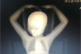 浙江一小女孩车祸后送医！拍个CT都是爱心图片