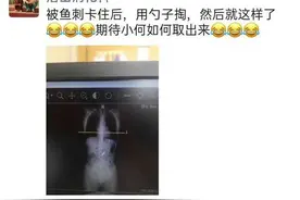 杭州女子崩溃：我吞了个勺子进去，14厘米长！事情要从一条鱼说起……图片