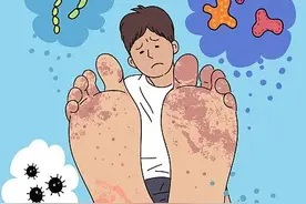 梅雨季皮肤科脚癣患者增加，爱穿这种鞋的要注意了图片