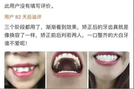 19.9元的牙套还真敢用！？24岁女生网购“整牙神器”，结果一口牙都毁了图片