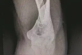 厚街 健身教练掰手腕掰断手臂图片