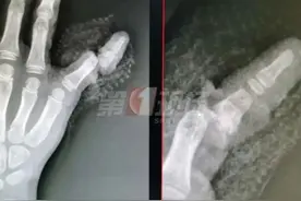 被阳台门夹断手指的女童出院了！家中事故频发，怎么防？图片