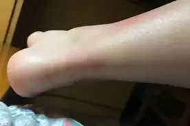 梅雨天，小伙踩了个水坑，腿烂一大片……近期多发，医生紧急提醒图片