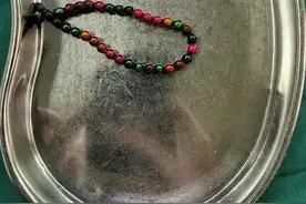 整整32颗！3岁男孩肚子被打开，医生揪心不已：家长真的别乱买图片