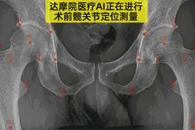 达摩院医疗AI新成果：0.3秒内完成髋关节置换手术前测量图片
