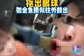 太可怕！模仿视频特效，浙江6岁男孩把自己眼球抠坏了图片