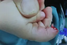 姐姐着急关门夹断妹妹手指 暑期儿童安全不可轻视图片