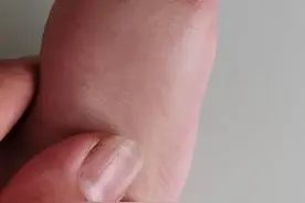 一幼儿小脚趾畸形，医生手术失误致截肢图片