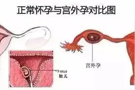 【妇产科普】警惕威胁女性生命安全的杀手——宫外孕（异位妊娠）图片
