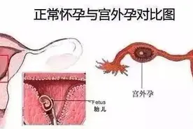 【妇产科普】警惕威胁女性生命安全的杀手——宫外孕（异位妊娠）图片