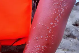 太心疼！空降兵抗洪胳膊晒出水泡图片