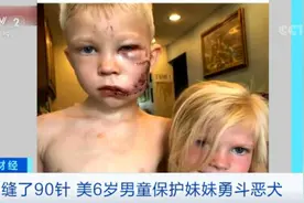 现实版的“超级英雄”！为保护4岁妹妹不受恶犬袭击 他被缝了90针图片
