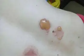 敷贴三伏贴起泡了，正常吗？图片
