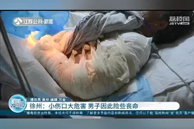 小伤口没往心里去，男子因此险些丧命 输了3000毫升血才救了回来图片