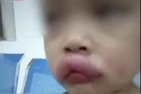 娃吃葡萄过敏，嘴唇嘟嘟，亲爹：虽然心疼但太好笑了图片