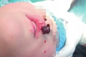 嘴唇上长出的“小樱桃”竟是化脓性肉芽肿，专家：孩子伤口长肿物要及时检查图片