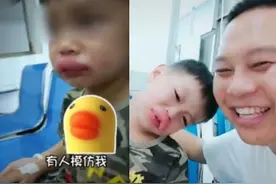 小萌娃疑因吃葡萄过敏肿成“嘟嘟唇”，水果过敏有这么大威力吗图片