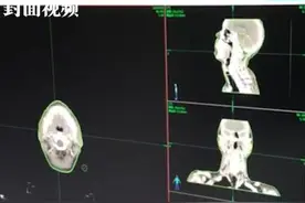 精准高效！利用AI技术3分钟内完成肿瘤放疗靶区勾画图片