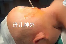 揪心！济南一岁大男童头部摔地，钢筋扎进颅内1厘米……图片
