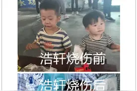 重度烧伤的6岁男孩挺住！我们正不顾一切奔向你图片
