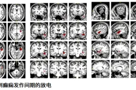 年轻小伙不分场合莫名“痴笑”专家精准置入电极根除病灶图片