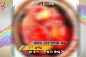 医生做手术，竟然被肿瘤“咬”了手！里面还有头发和牙齿图片