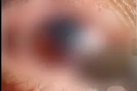女孩保温杯泡红枣10多天后拧开“爆炸”，致眼球破裂，医生这样说图片