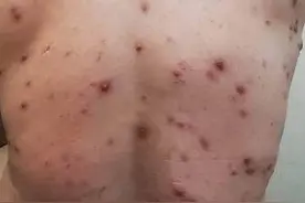 脸背颊狂窜痘！小鲜肉健身狂喝高蛋白　没练成猛男先成豆花男图片