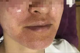 皮肤鸦片！杭州一妙龄女子停用美容院的这款产品后“毁容”了图片