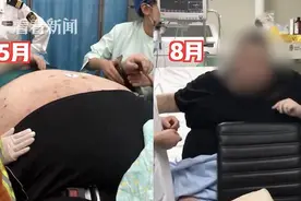 500斤的他做手术了，预计瘦近一半图片