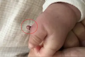 家长“土法”勒“六指”女婴左手险被废图片