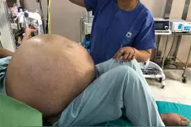 世界上最大的卵巢肿瘤被成功摘除 重达100斤图片
