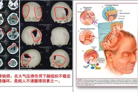 9岁男童脑外伤昏迷1年 迷走神经刺激术带来新希望图片