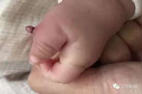 女婴多长一根指头，家长用了个办法想让它脱落，结果左手差点废了……图片