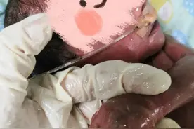 太心疼！脸上及四肢“油光光”，刚出生的“火娃”多处皮肤破损、断裂……图片