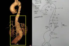省立医院血管外科分别应用开放及腔内技术治疗复杂胸腹主动脉瘤图片