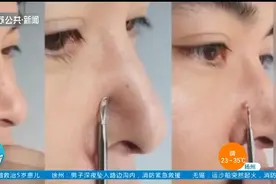 19岁女孩挤痘痘引发颅内感染，面部“危险三角区”请注意！视频封面