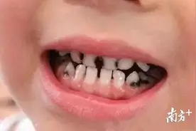 孩子有“小黑牙”，只能干瞪眼？避免儿童长蛀牙，家长必看图片